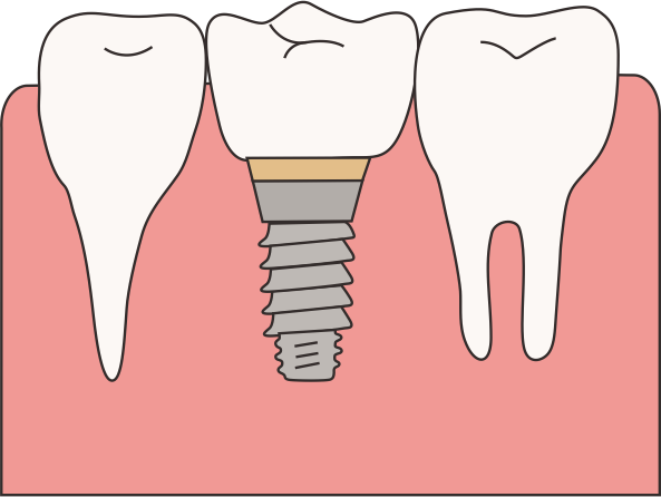 亿牛策略 种好的牙“离家出走”？从原因到规避，一篇说清